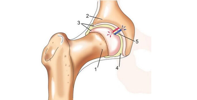 klubo sąnarys ir artrozė