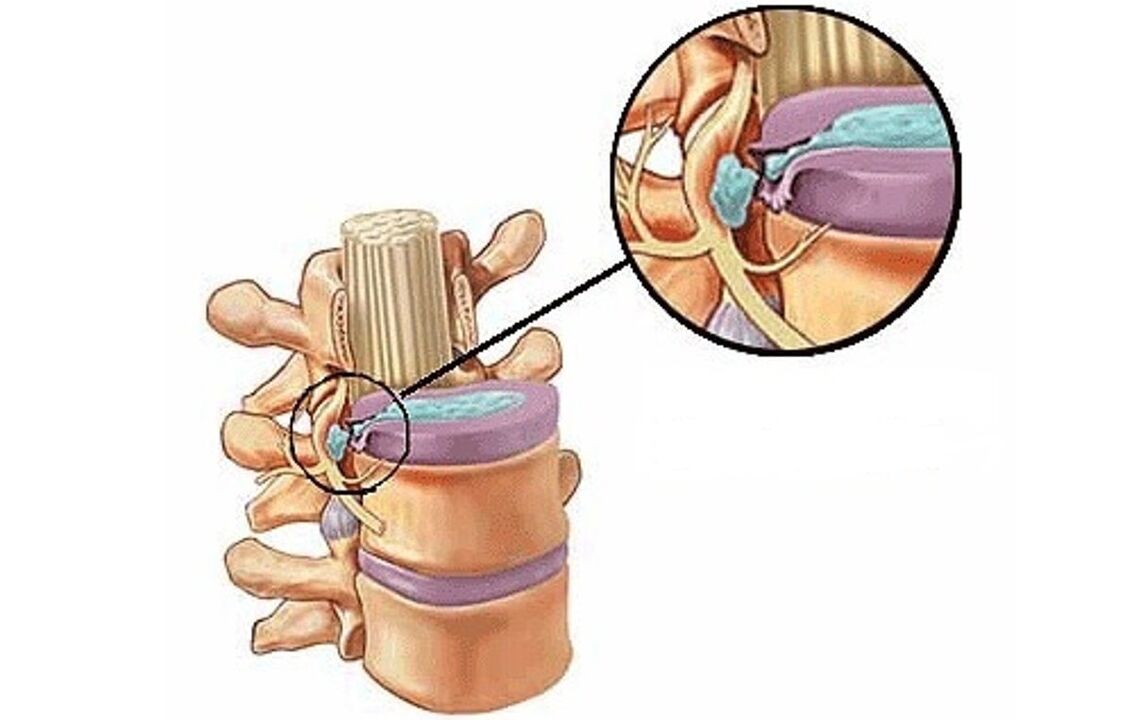 tarpslankstelinė išvarža su krūtinės ląstos osteochondroze